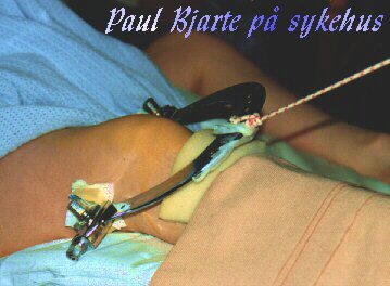 Paul Bjarte på sykehus